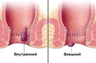 Первая помощь при геморрое