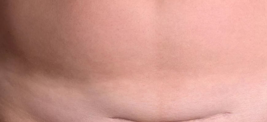 Последствия кесарева сечения: подробный разбор для будущих мам